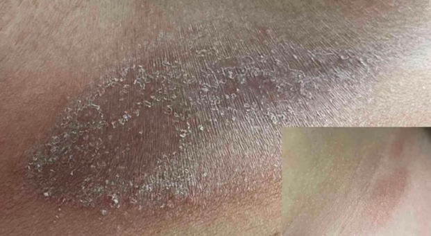 Dry Skin