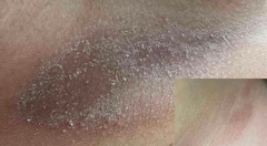 Dry Skin